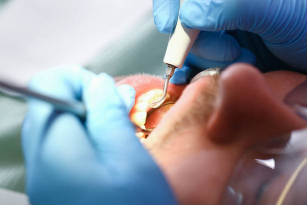 Best Emergency Dentist for Lost Fillings or Crowns in Helper, UT