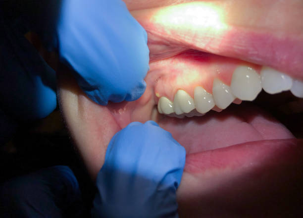 Best Emergency Dental Care for Abscessed Tooth in Helper, UT